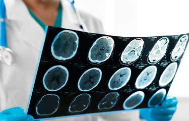 Gehirnscan - Alzheimer-Demenz